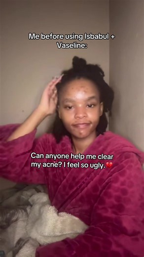Isibabuli Vaseline Acne Combo: Real Results in 1 Month