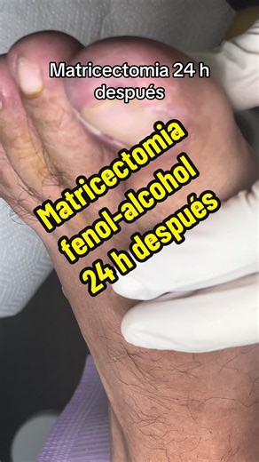 Matricectomía: Resultados 24 Horas Después
