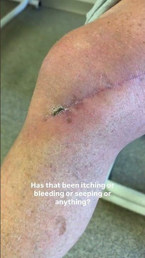 Jiffy Knee Total Knee Replacement