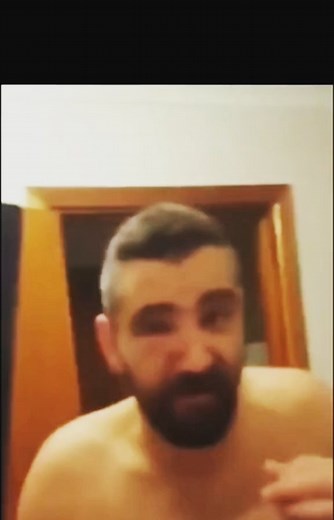 Best Pimple Popping Videos on Instagram: "WOW how big that was! #blackheads #satisfying #relaxing #satisfyingvideo #blackheadremoval #blackheadremoval #popping #blackhead #pimple #pimplepopping #addict #relax #video #viralvideo #ear #earpimple #ingrownhair"