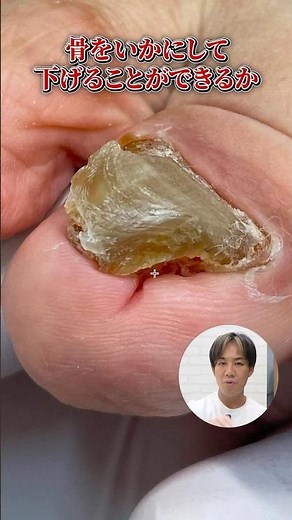 様々な変形した爪をご紹介！｜全てに共通する原因を巻き爪のプロが解説します