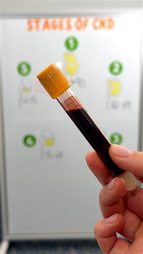 Kristine Tuttle on Instagram: "Stages of Chronic Kidney Disease🫘⁠ ⁠ CKD is the gradual, irreversible loss of kidney function that happens over time. When the kidneys stop filtering properly, waste products build up in the body.⁠ ⁠ 🧪GFR = measures how well the kidneys filter blood⁠ ⁠ ⬇️Kidney function = ⬇️GFR⁠ ⁠ - Stage 1 -⁠ GFR > 90⁠ Kidney damage with normal or high GFR⁠ ⁠ - Stage 2 -⁠ GFR 60 - 89⁠ ⁠ - Stage 3 -⁠ GFR ⁠ A: 45 - 59 ⁠ B: 30 - 44⁠ ⁠ - Stage 4 -⁠ GFR 15 - 29⁠ ⁠ - Sta