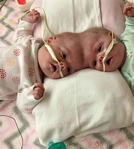 Doctors performed a unique surgery in which conjoined twins who shared a common skull and head were separated. Look at them now. The twins born with the same head have gone through many tests. They had two different bodies but one head. The parents made the decision and immediately demanded surgery to separate the twins. 😥😥 Five months after surgery, the twins were successfully separated. They had the most difficult issues during their care time, but everything went well. You will be amazed to