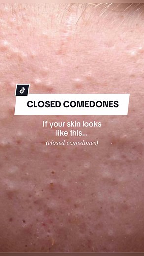 Tips for Closed Comedones: Skincare Routine for Acne Prone Skin