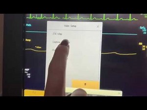 Capturing a 12 Lead on the Philips Bedside Monitor