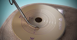 Causes of sore skin around your stoma