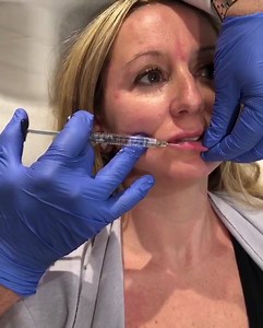 The beautiful winner of our VALENTINES Day lips COMPETITION receiving a Dermal Filler Lip Enhancement by @dr.tass 💋💋 🥀Call 1300drtass or visit www.drtass.com.au Port Melbourne- Ripponlea- Crown Towers - Toorak- Warragul #drtass #drtasscosmeticclinics #drtasscosmeticandskinclinics #drtassskinclinics #drtassskincare #dermalfillers #lipenhancement #lipinjections #pout #kissablelips #cosmeticenhancement #plasticsurgery #cosmeticsurgery #nonsurgical #cosmeticdoctor #melbourne #crowntowers #crownsp