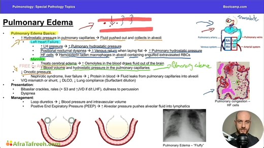 Pulmonary Edema