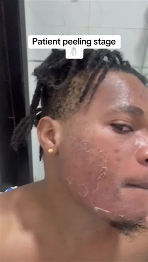 Understanding the Peeling Stage of Chemical Peels