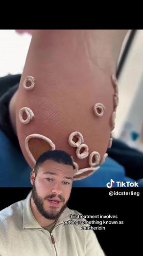 Plantar Warts Removal Procedure Explained