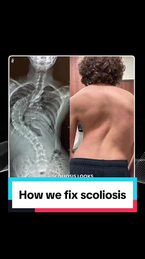 How to Treat Scoliosis and Kyphosis for Back Pain Relief
