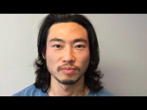Amazing Eyebrow Transplant FUE on Male Patient