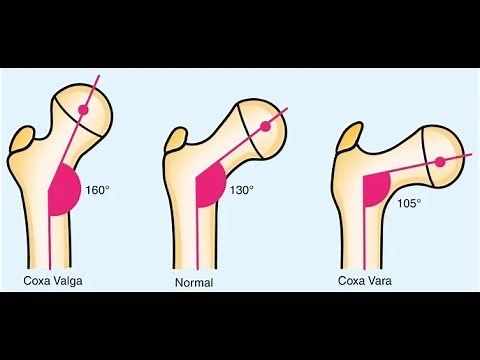 Pearls about Coxa Valga and Coxa Vara