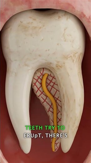 Why Your Wisdom Teeth Hurt SO Bad 🦷