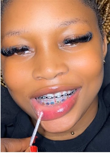 Fashion Braces to Elevate Your Style