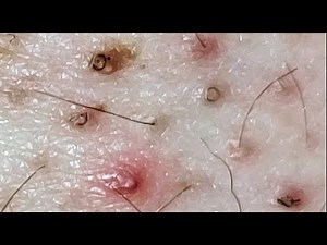 Ingrown Hairs and POPS!