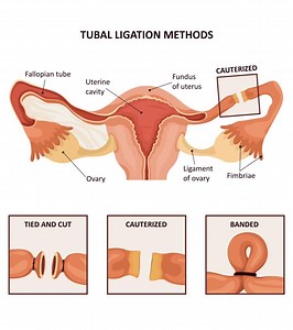 Tubal Ligation: Complete Guide On Benefits, Risks, And Recovery
