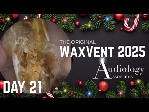 Huge Mastoid Cavity Plug + Full Skin Peel! - Waxvent Day 21