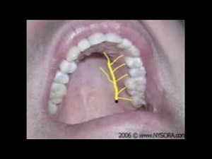 GP greater palatine nerve block