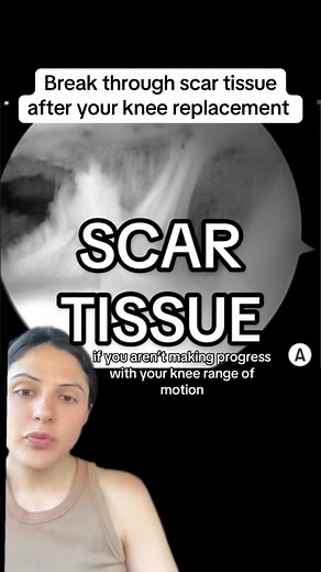 Effective Strategies to Reduce Scar Tissue Post Knee Replacement