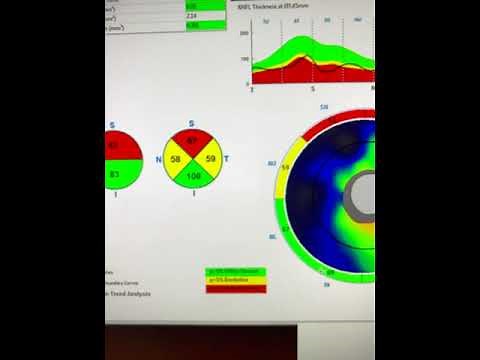 Using OCT optic nerve imaging for glaucoma