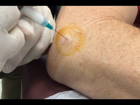 Tennis Elbow Cortisone Injection, Epicondylitis Treatment for Marco