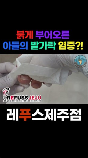 붉게 부어오른 아들의 발가락 염증?! 😭 3개월 만에 수술 없이 통증 제로 3TO 교정으로 깨끗한 일자 발톱 되찾아준 리얼 성장 대장정! (레푸스제주 노형점)