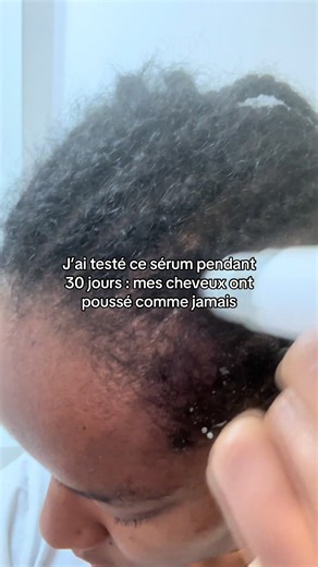 J’ai testé ce sérum pendant 30 jours… et mes cheveux ont poussé comme jamais 🤯 Pendant des mois : ❌ pousse lente ❌ cheveux cassants ❌ longueurs qui stagnaient En 30 jours avec ce sérum : ✨ pousse visible ✨ cheveux plus forts ✨ moins de casse ✨ cuir chevelu nourri Ce n’est pas de la magie. C’est la régularité les bons ingrédients au bon endroit. Si tu es fatiguée de tester 10 produits sans résultat, 👉🏽 ce sérum peut clairement faire la différence. 💬 Tu veux le tester ? Commente « SERUM »
