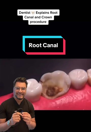 Root Canal Procedure and Crown Preparation Explained