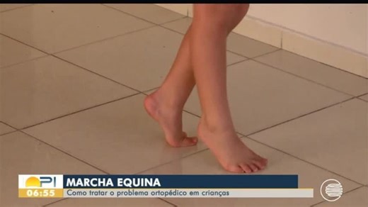 Marcha equina: como tratar problema ortopédico em crianças