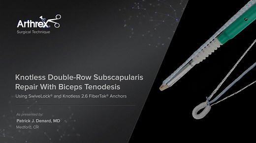 Knotless Double-Row Subscapularis Repair With Biceps Tenodesis Using SwiveLock® and Knotless 2.6 FiberTak® Anchors