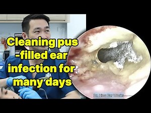 Cleaning pus filled ear infection for many days | ear cleaning | ASMR earwax | soothing | relax |
