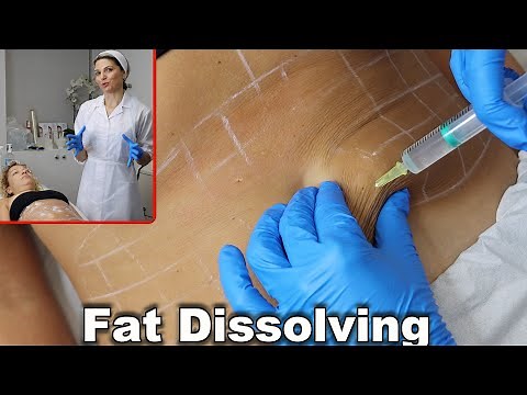 Fat Dissolving injections on stomach (2023). Non surgical liposuction