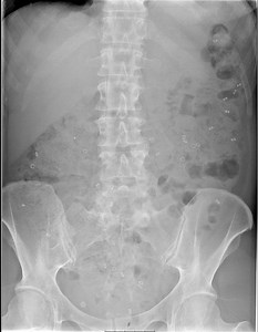 Transit-Pellets Radiopaque Markers