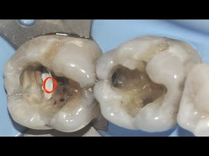 Use the Latest Materials to Protect the Pulp and Enhance Your Restorations