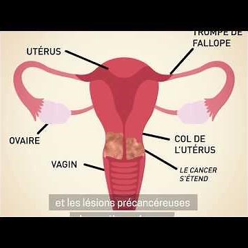 Prévention et traitement du cancer du col de l'utérus