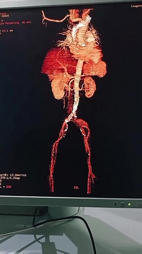 Tac. Tórax, abdomen y pelvis con doble contraste// Reconstrucción 3D Fase arterial ☢️#tomo #radiologi #radiologylife #tomografia #tomografy