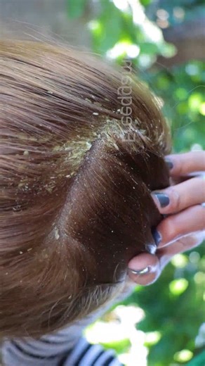 Dandruff Removal With Comb Satisfying - Big Flakes Scalp Scratching And Picking #251 #removetick #Dandruff #dandrufftreatment #dandruffremoval #fblifestyle | Gabriela Blair