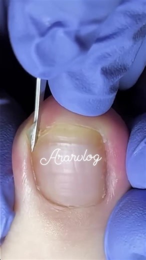 25K views · 201 reactions | Nail Cutting #followers #reelsviral #reelsvideo #pedicure #friends | Ar Ar Vlog | Facebook