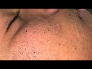 Deep Cleansing Techniques For Acne Prone Skin — Severe Whitehead Removal