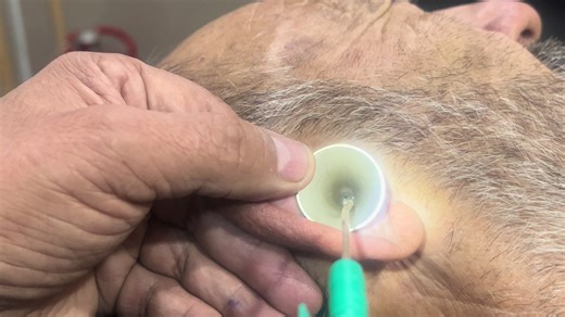 Ear Wax Removal for Elderly: Immediate Patient Relief