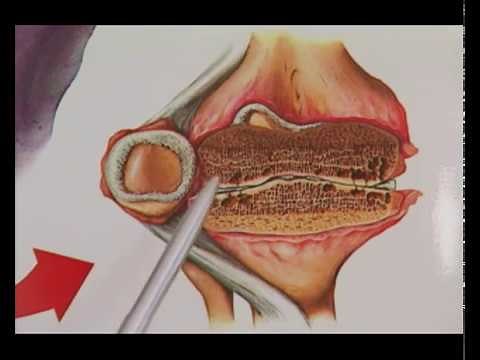 Informations und Patientenfilm zur MBST Kernspinresonanz-Therapie