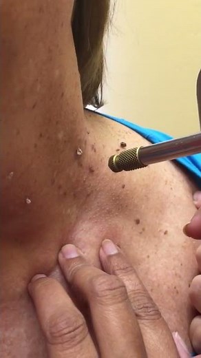 Skin tag removal