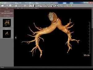 CT Angiography case19 Pulmonary Embolism