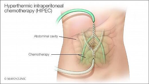 Mayo Clinic Q&A podcast: Hot chemotherapy for late-stage cancers - Mayo Clinic News Network
