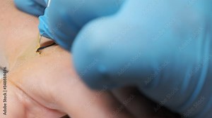 microchipping human. microchip is implanted under skin on man hand close-up.