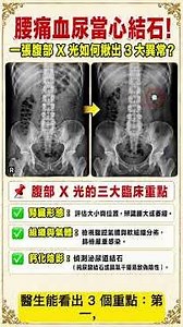 [Doctor Explains] Beware of Kidney Stones if You Have Back Pain and Blood in Your Urine! How Can ...