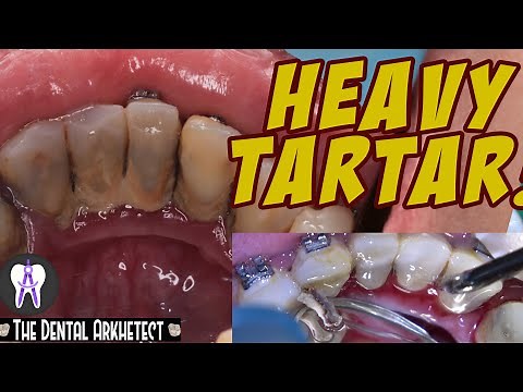 Tooth Cleaning w/ Ultrasonic Scaler (Oral Prophylaxis) 4K #C14