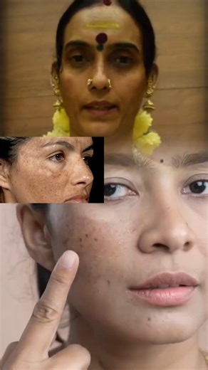 Best Home Remedy for Melasma 😍 | முகத்தில் உள்ள மங்கு மறைய ✨ #shorts #melasma #fyp #trending