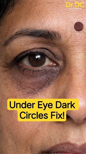 Tired of Dark Circles? This Will Blow Your Mind! | Dr DC, Plastic Surgeon | Pune
